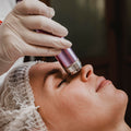 FACIALS - CO Fractional Laser